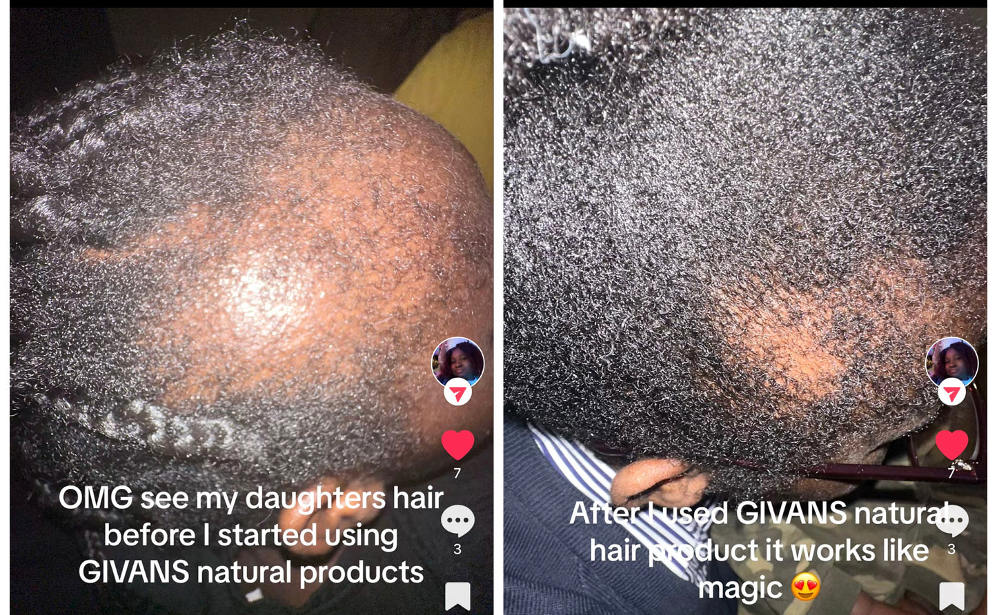 100ml Ayurvedic Hair Growth Oil For Hair Loss